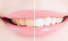 Sbiancare denti