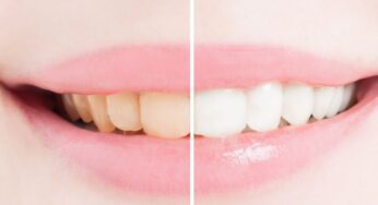 Se vuoi sbiancare i denti prova uno di questi 10 rimedi naturali: funzionano da sempre